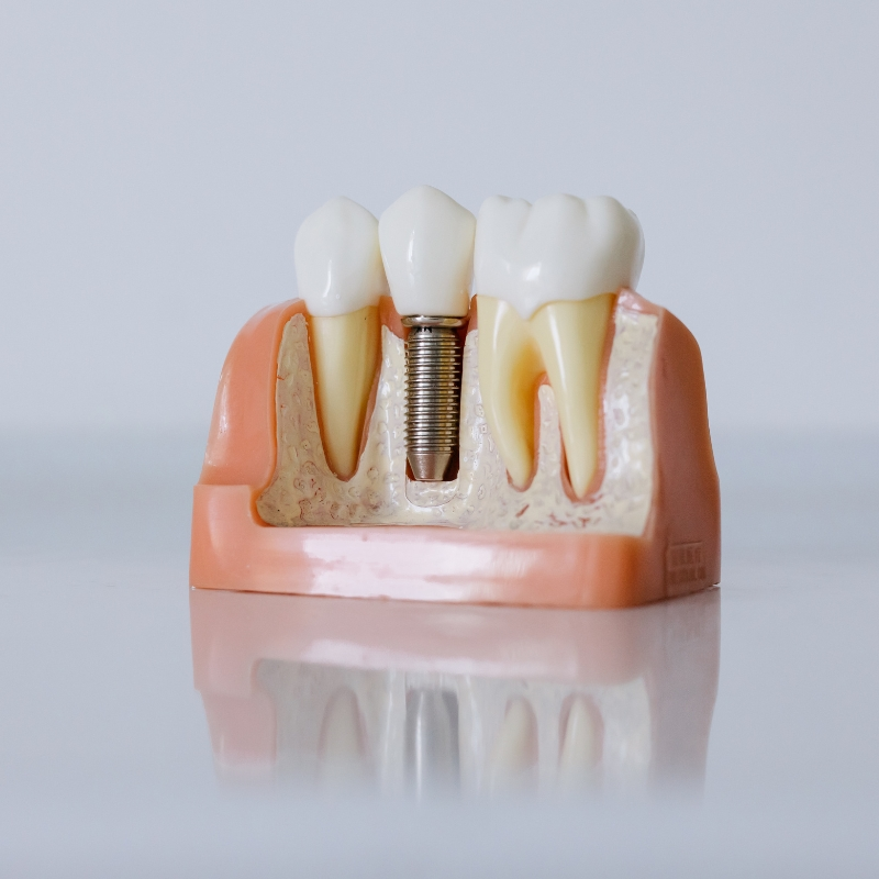 Model dentalnog implantata između prirodnih zuba